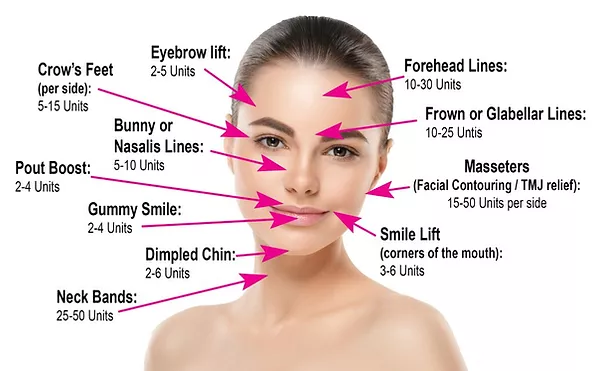 Chart of a woman's face showing where botox can be injected and how many units.