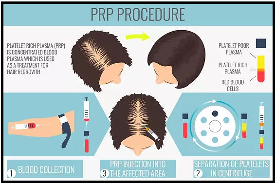 Infographic chart showing the three steps that make up a PRP procedure.